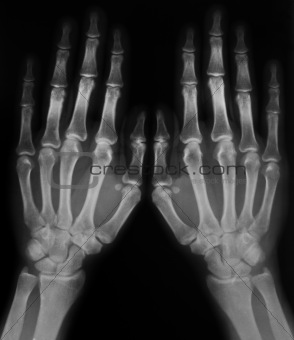 x-ray of hands