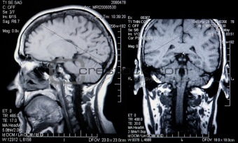 Real MRI Scans of the Head and Brain