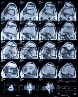 MRI knee