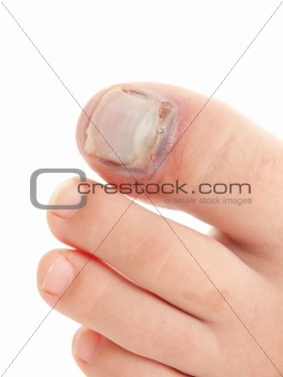 Broken big toe with nail detachment