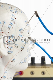 electric-acupuncture