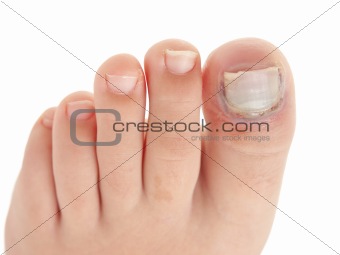 Broken big toe with nail detachment 