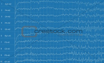 Brain wave electroencephalogramme (EEG)