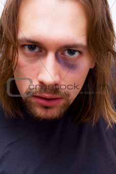 Young man with black eye 