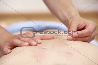 Acupuncturist treating female client