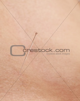 Acupuncture needle