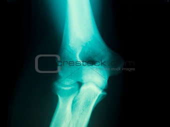 x-ray of a male arm joint