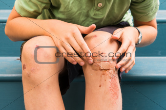 Young boy with scrapped knees and band aids