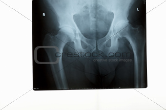 An x-ray of a pelvis