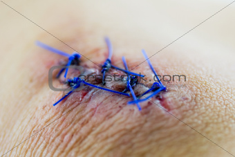 Closeup of a stitched wound
