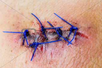 Closeup of a stitched wound