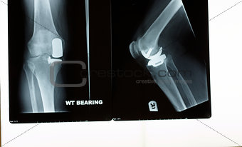 An x-ray of a knee replacement
