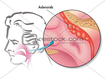 adenoids