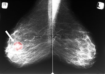 Mammogram with breast cancer