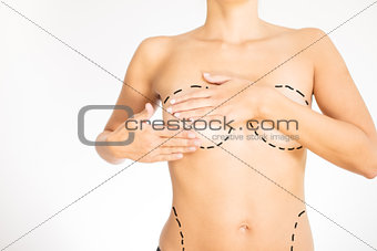 Naked torso of a woman marked for surgery