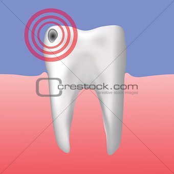 hole in the tooth