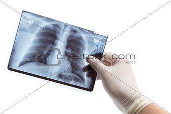 Male hand in medical glove holding lung radiography 