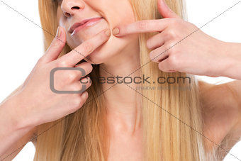 Closeup on teenager popping pimple