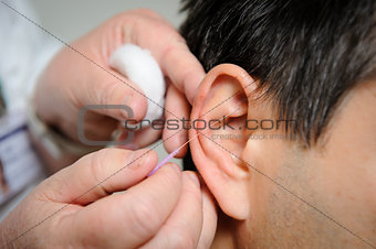 Acupuncture. Needles being inserted into a patient's ear