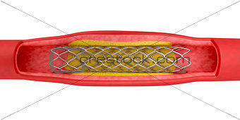 Angioplasty with stent placement