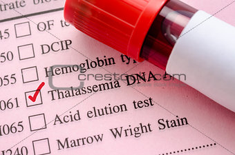 Sample blood in blood tube for Thalassemia DNA test.