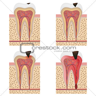 Development of dental caries illustration.