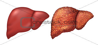 Liver of healthy person. Liver patients with hepatitis. Liver is sick person. Cirrhosis of liver. Repercussion alcoholism