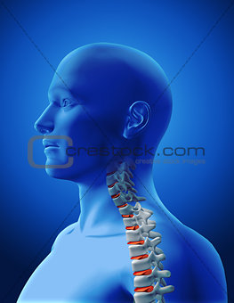3D medical image showing spine with highlighted discs