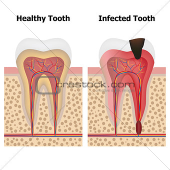 Pulpitis and Healthy tooth