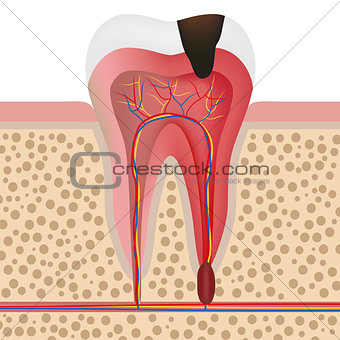 Illustration of infected tooth