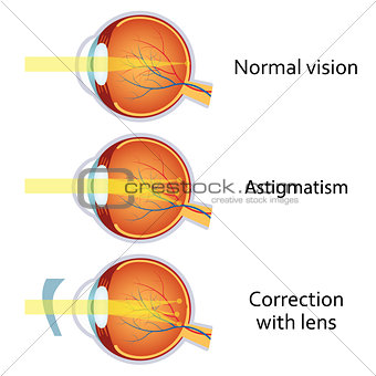 Astigmatism corrected by a cylindrical lens.