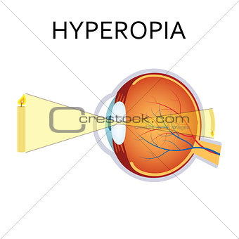 Hyperopia eyesight disorder.