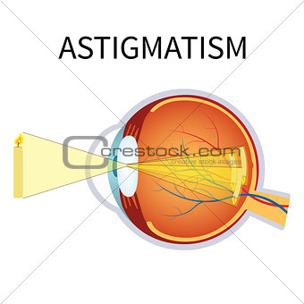 Illustration of astigmatism.
