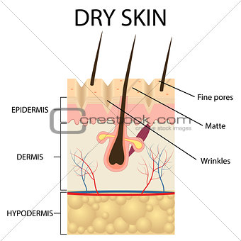 Illustration of The layers of dry skin