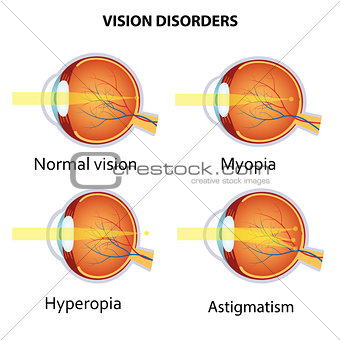 Common vision disorders.
