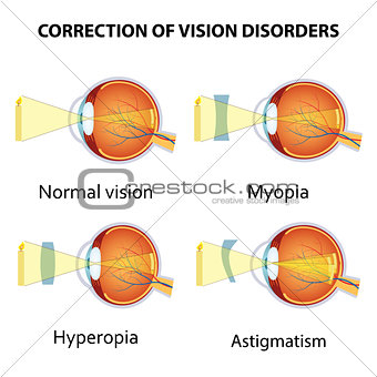 Correction of eye vision disorders by lens.