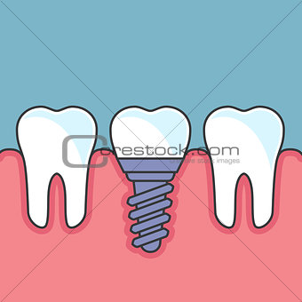 Row of teeth with dental implant - dental prosthetics