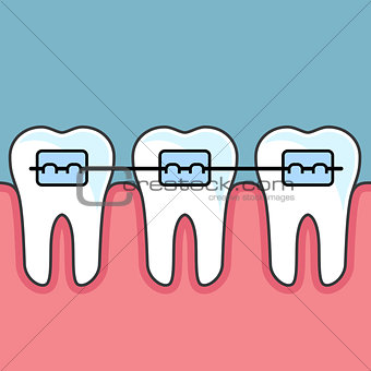 Teeth with dental braces - dental arrange