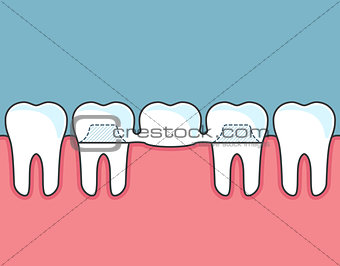 Dental bridge and row of teeth 