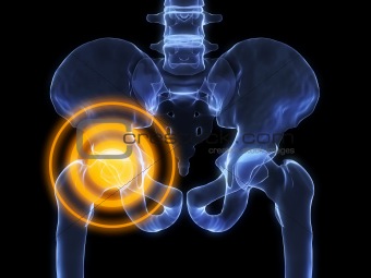 x-ray hip inflammation