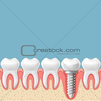 Row of teeth with dental implant - teeth prosthetics scheme, gum