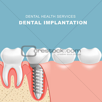 Gum section with dental implantat - row of teeth