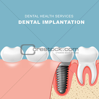 Teeth and dental implantat inserted into gum - tooth implantatio