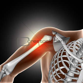 3D medical image showing broken bone in arm