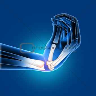 3D medical image of a painful bent wrist