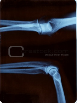 Elbow radiography